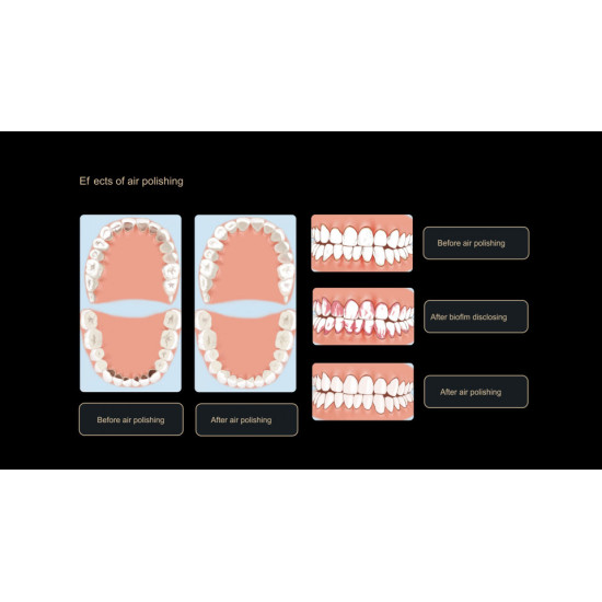 Woodpecker Aparat profilaxie AP-H Plus (supragingival si subgingival)