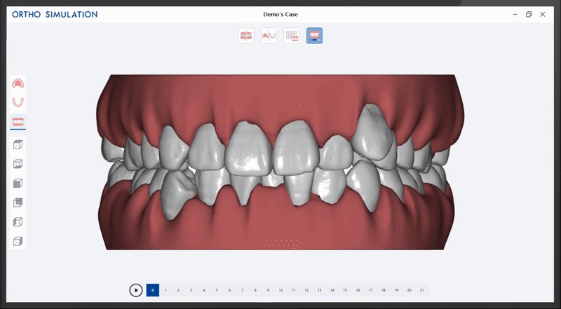 Simulare ortodontică – software Alliedstar