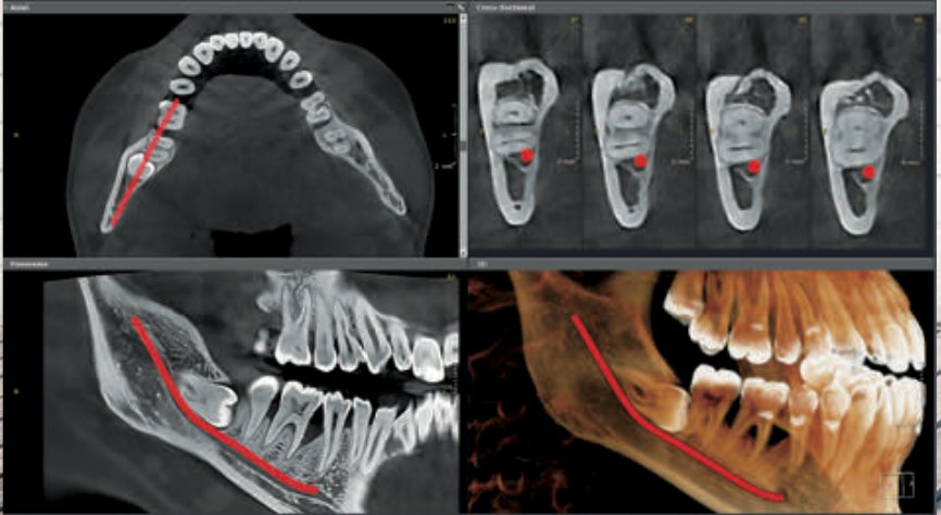 Molar inclus și canal mandibular în CBCT