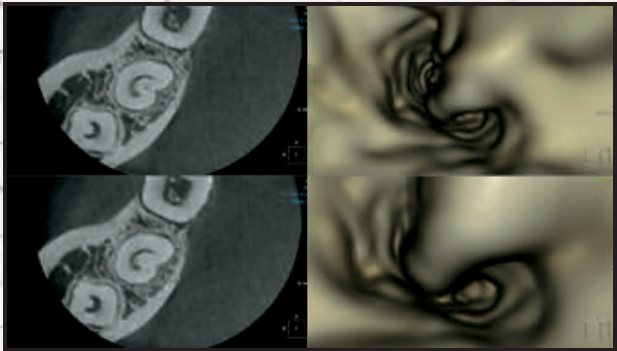 Canal în formă de C vizualizat endoscopic în CBCT