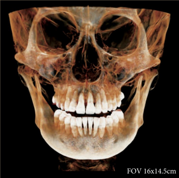 Volum CBCT 16 × 14,5 cm realizat cu DENTRI-Sα