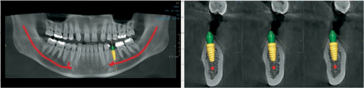 Planificare implantologică pe imagini CBCT
