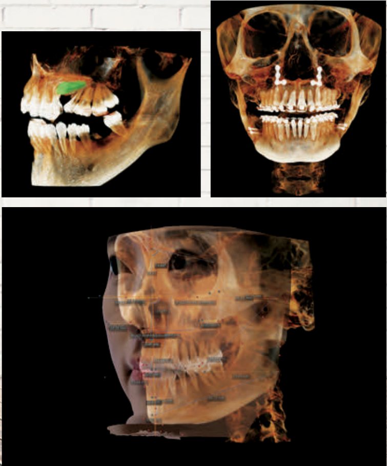 Analiză 3D ortodontică și scheletală