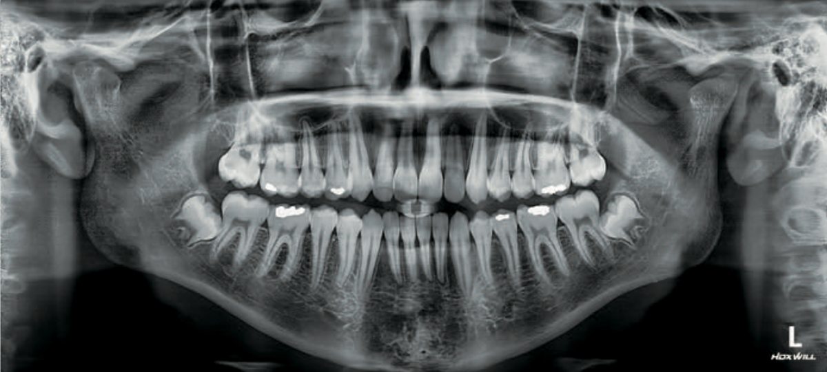 Radiografie panoramică HDX WILL