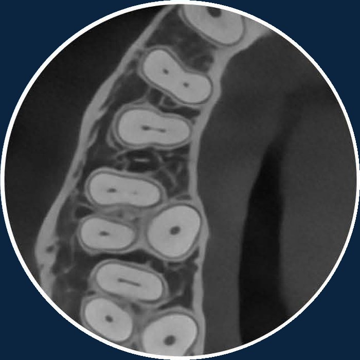 Voxel 70 µm pentru endodonție