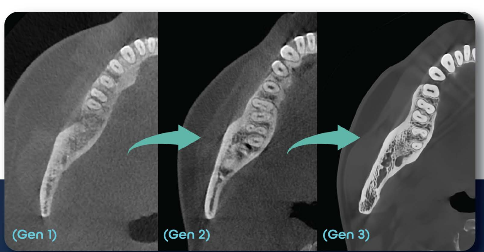 Evoluția algoritmului de reconstrucție HDX WILL: Gen 1, Gen 2 și Gen 3