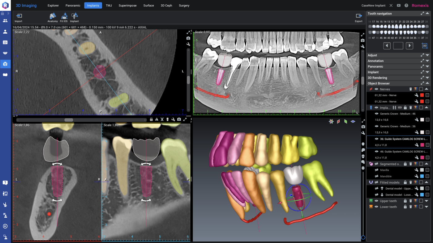Romexis Smart Implant