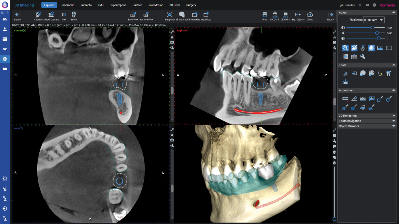 Romexis Implant Planning