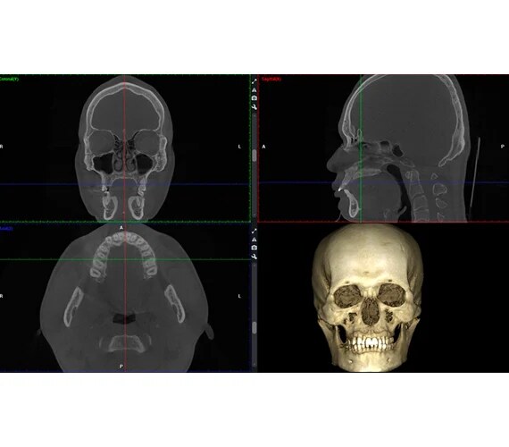 Imagini clinice realizate cu Planmeca Viso G7