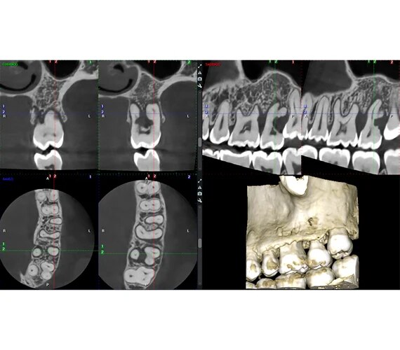 Imagistică endodontică cu Planmeca Viso G7