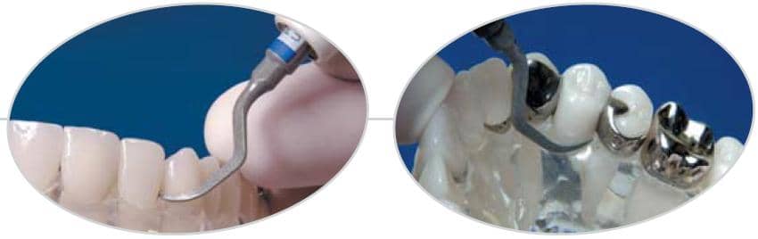 Ansa implant PH1 în utilizare