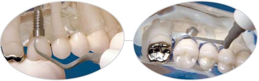 Ansa implant PH2L în utilizare