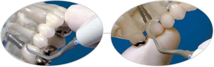 Ansa implant PH2R în utilizare